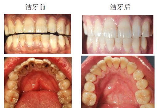 爱牙日 | 刷牙能代替洗牙吗?