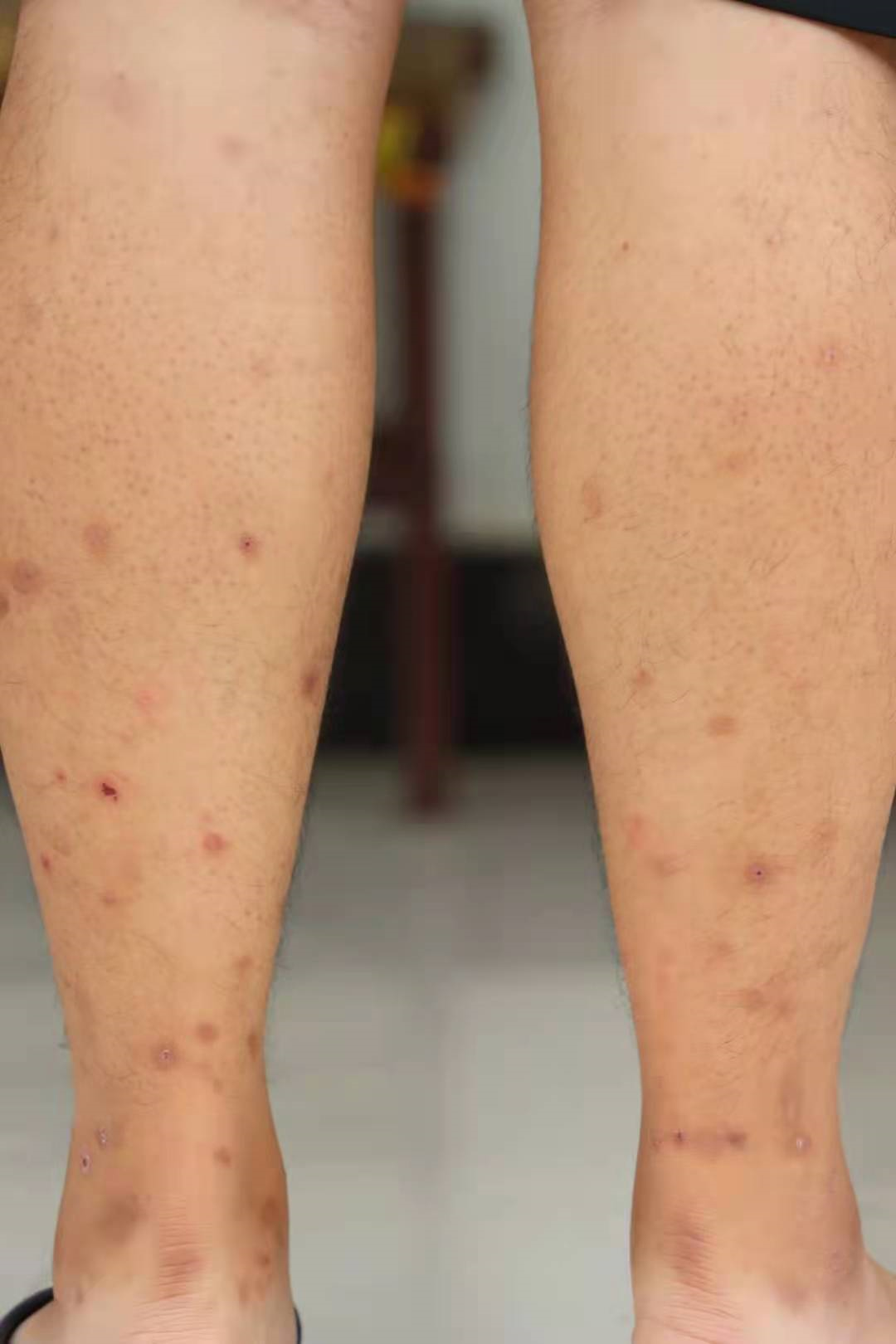 【同心战疫】他的小腿被叮咬到蚊子"无处下嘴"